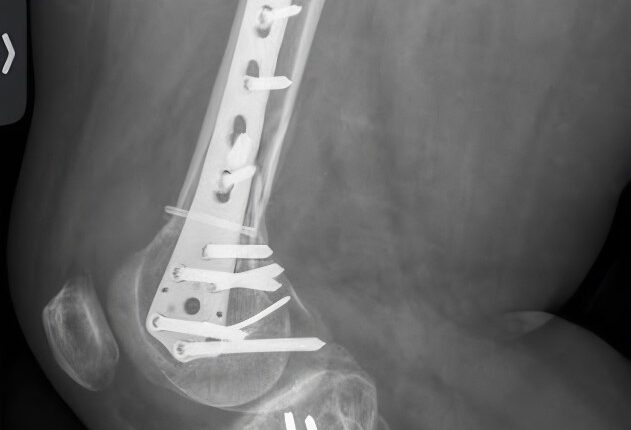 Some of Colt’s leg injuries – Instagram